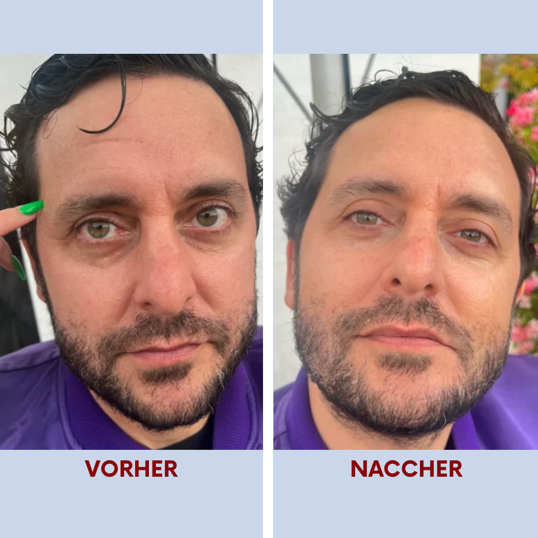 Depura | Rote-Licht-Therapie unter den Augen